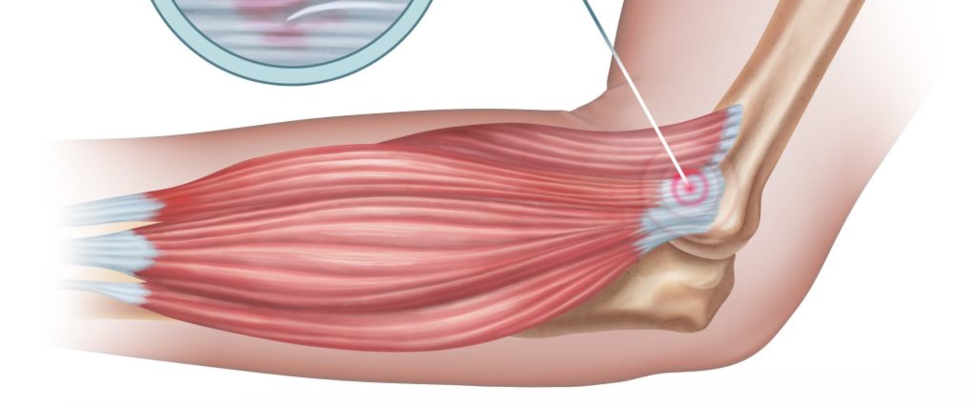 Understanding Tennis Elbow: An In-Depth Look at Soft Wave Therapy for Tendon Injuries