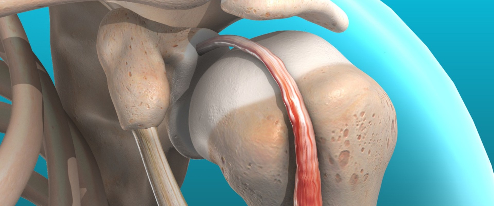 Understanding Rotator Cuff Tendinitis: The Benefits and Risks of Soft Wave Therapy