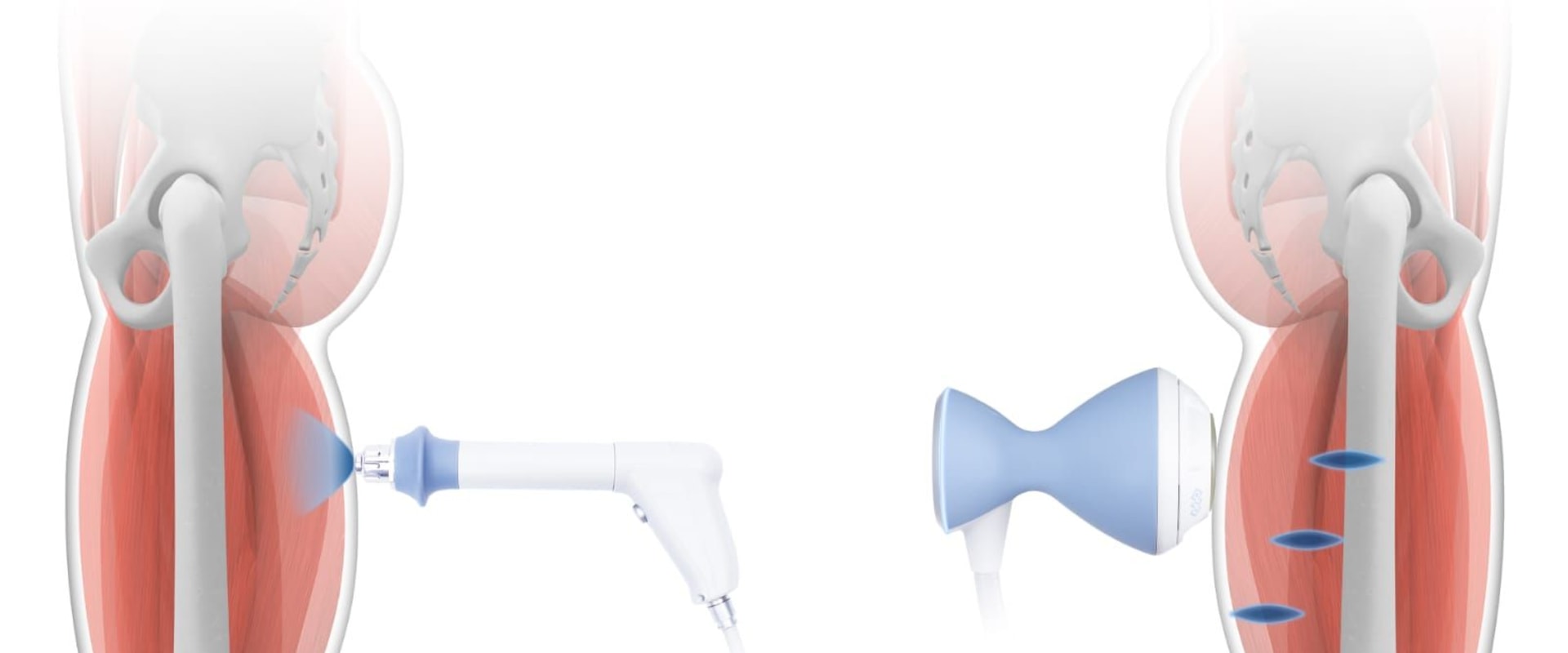 Understanding Soft Wave Therapy: Comparing it with Other Treatments