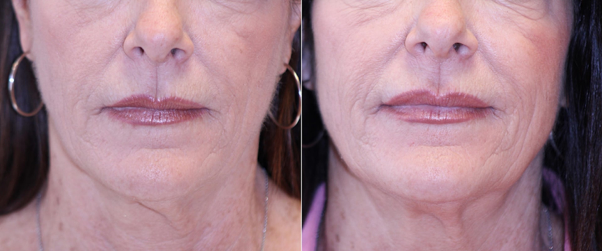 Understanding Allergic Reactions and Soft Wave Therapy