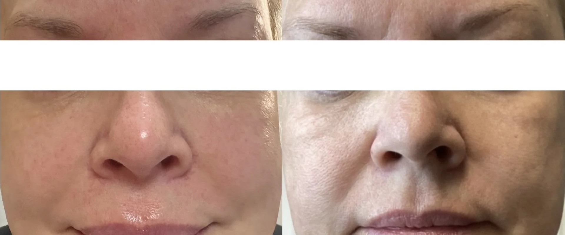 How long does it take for softwave therapy to work?