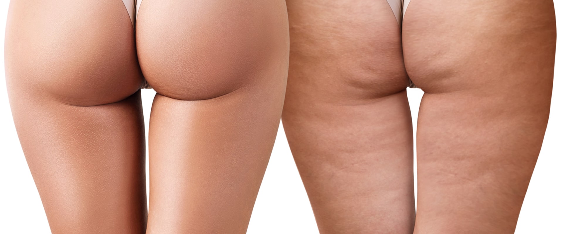 Soft Wave Therapy for Cellulite Reduction: How It Works and What to Expect