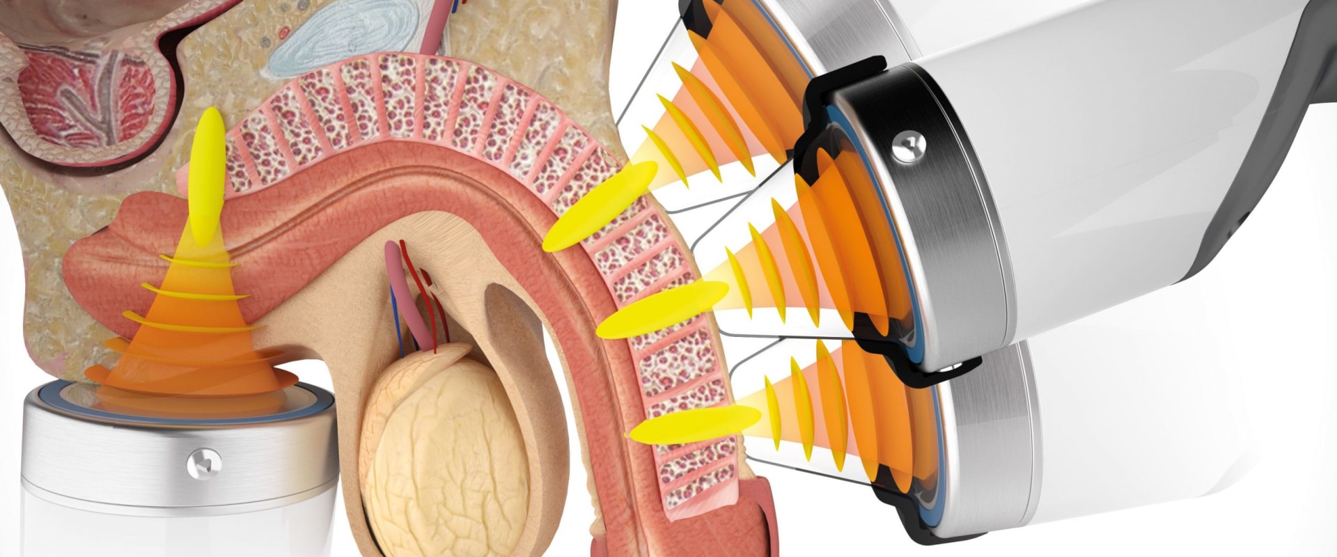 Understanding the Uses of Soft Wave Therapy for Erectile Dysfunction