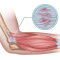 Understanding Tennis Elbow: An In-Depth Look at Soft Wave Therapy for Tendon Injuries