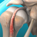 Understanding Rotator Cuff Tendinitis: The Benefits and Risks of Soft Wave Therapy