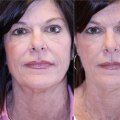 Understanding Allergic Reactions and Soft Wave Therapy