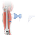 Understanding Focused Soft Wave Therapy