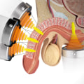 Understanding the Uses of Soft Wave Therapy for Erectile Dysfunction