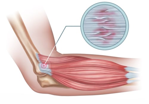 Understanding Tennis Elbow: An In-Depth Look at Soft Wave Therapy for Tendon Injuries