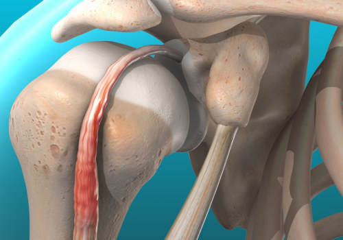 Understanding Rotator Cuff Tendinitis: The Benefits and Risks of Soft Wave Therapy