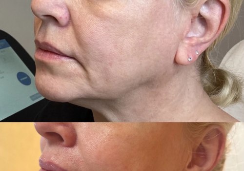 Does softwave therapy really work?