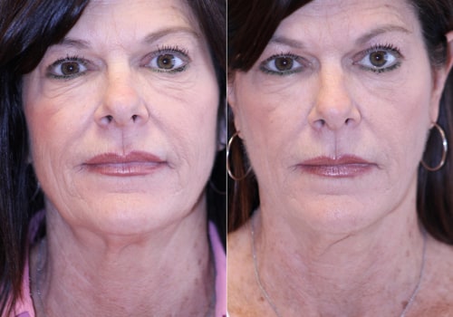 Understanding Allergic Reactions and Soft Wave Therapy