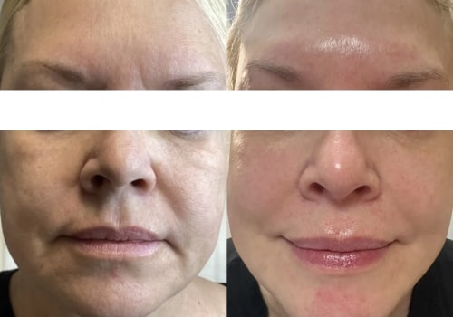 How long does it take for softwave therapy to work?