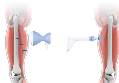Understanding Focused Soft Wave Therapy