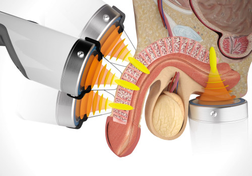 Where should you not use shockwave therapy?