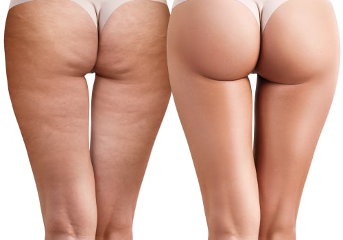 Soft Wave Therapy for Cellulite Reduction: How It Works and What to Expect
